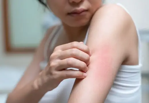 Ngải đen ngâm rượu có tác dụng gì? Những lợi ích ít ai biết 4 Ngải đen ngâm rượu giúp điều trị vấn đề ngoài da