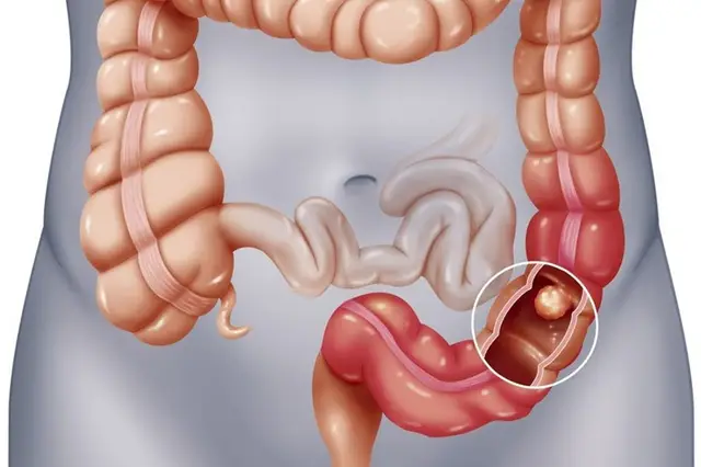 Ngải đen - Bài thuốc hay trong điều trị viêm đại tràng-01