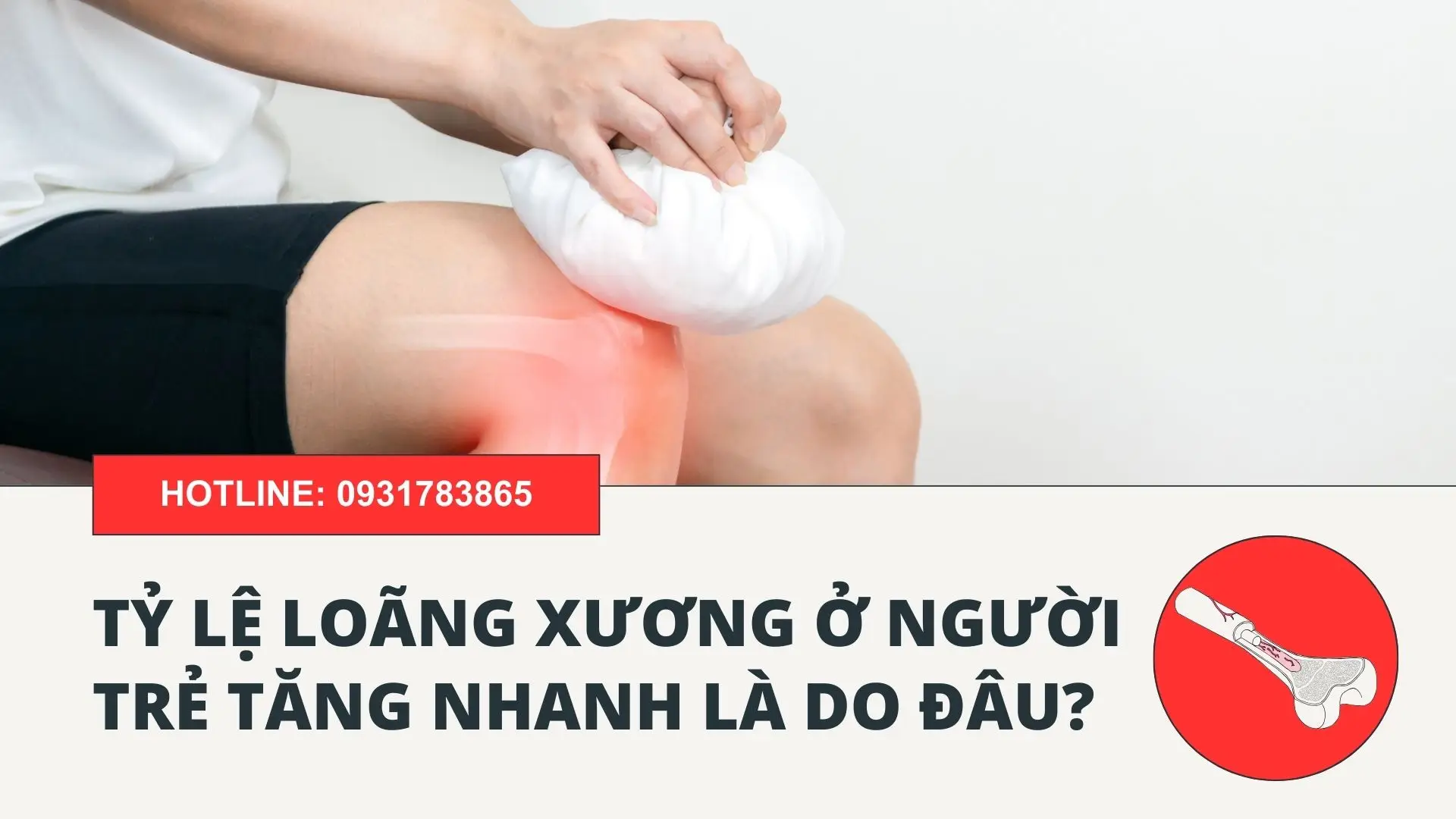 Tỷ lệ loãng xương ở người trẻ tăng nhanh là do đâu và cách phòng ngừa 1 Tỷ lệ loãng xương ở người trẻ tăng nhanh là do đâu và cách phòng ngừa